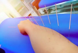 acupuncture-arm
