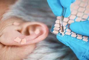 acupuncture-ear