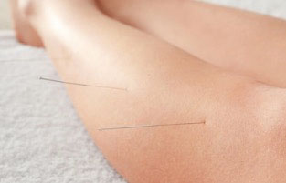 acupuncture-leg